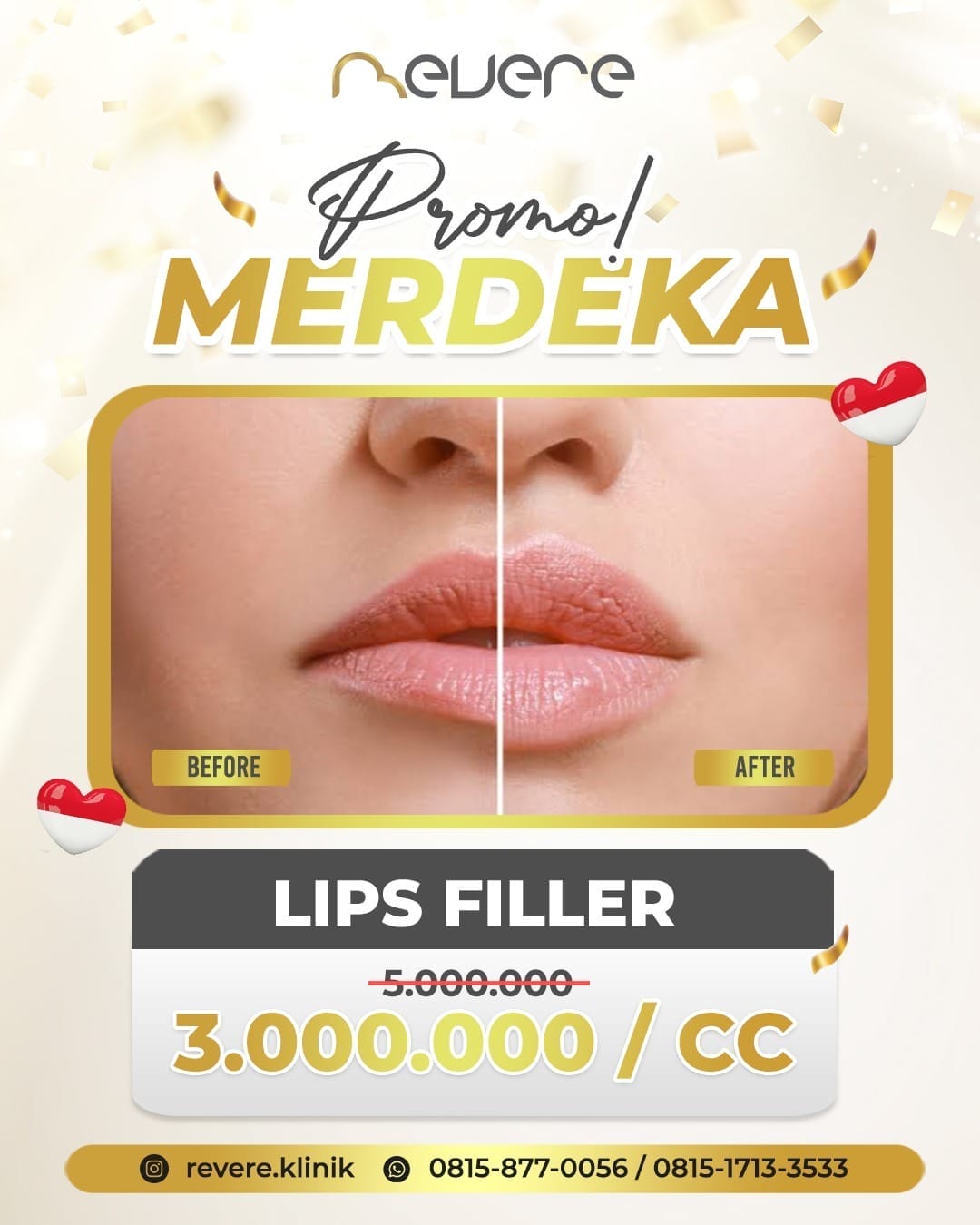 Filler bibir